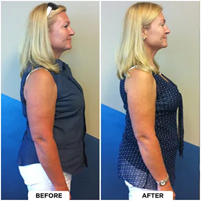 Healthy Lifestyle Support | Lakeside Spine And Wellness June 15, 2026 Chiropractic-renton-wa-woman-before-after